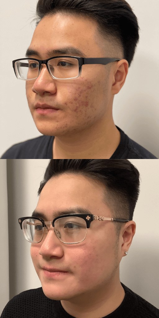 Isotretinoin / Accutane After