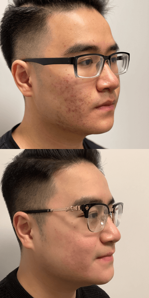 Isotretinoin / Accutane Before
