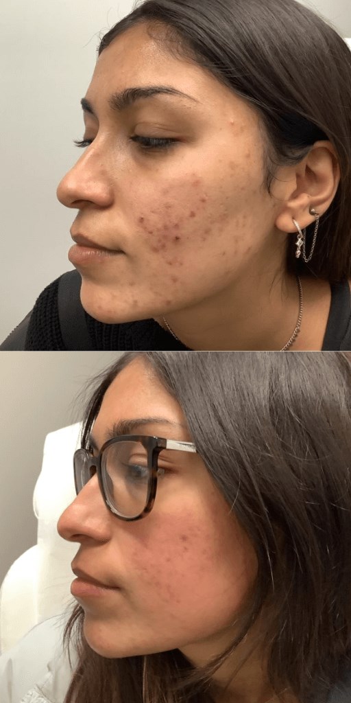 Isotretinoin / Accutane After