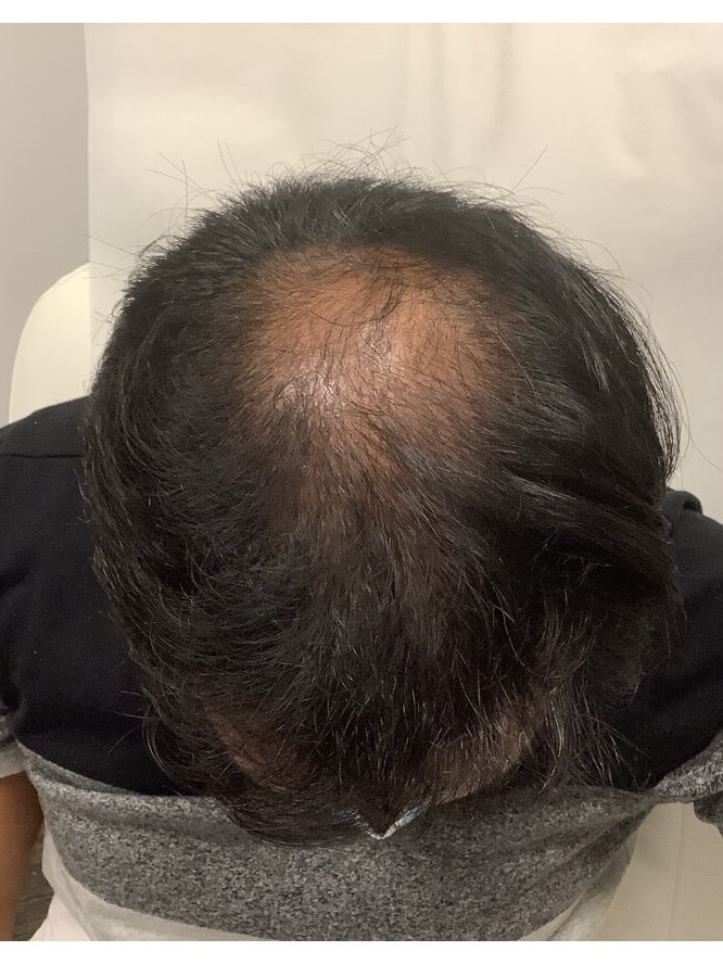Hair Loss After