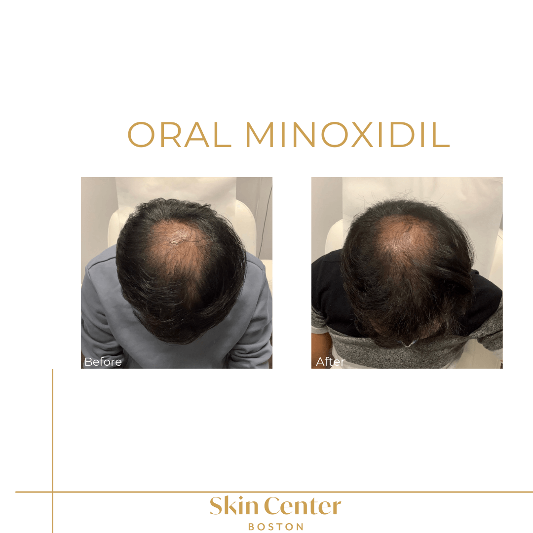 Minoxidil PILLS FOR HAIR LOSS  QA hair loss  lasers  Dr Dray  YouTube