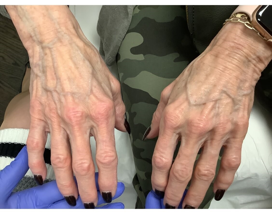 Radiesse hand treatment Before