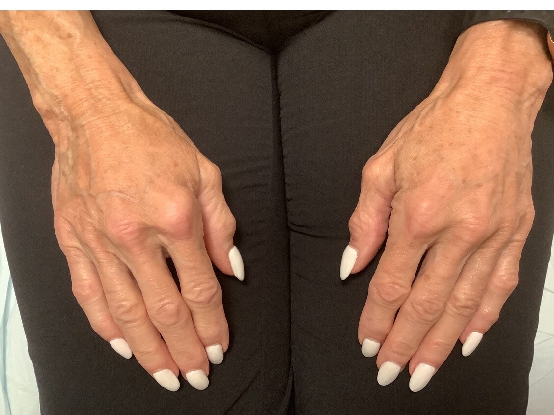 Radiesse hand treatment After