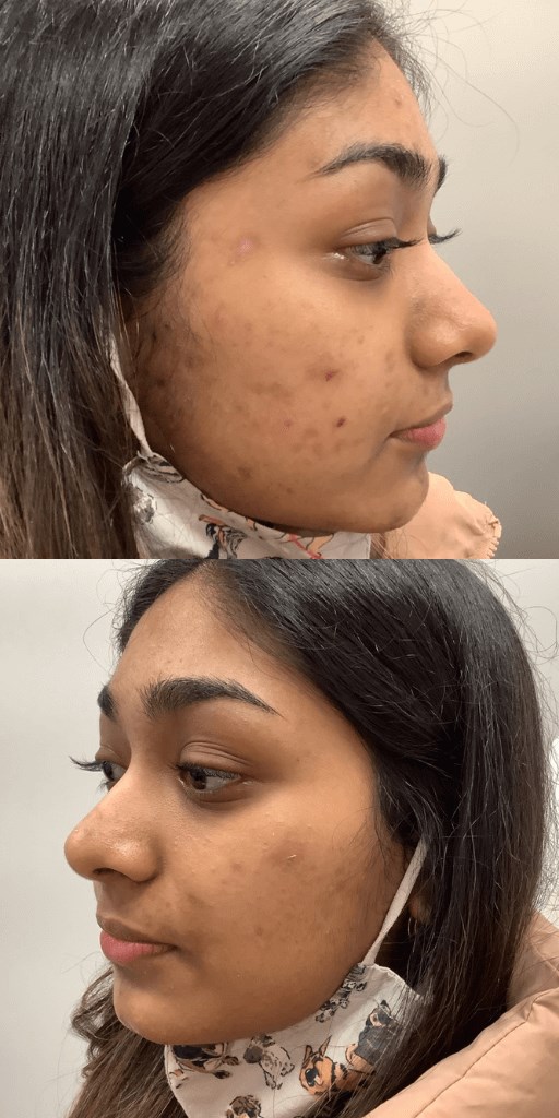 Isotretinoin / Accutane Before