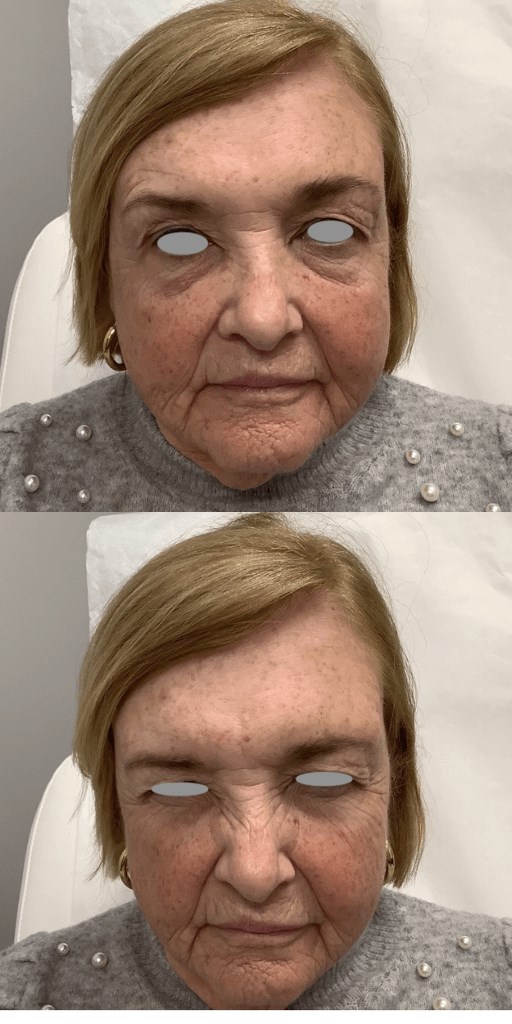Botox / Xeomin After