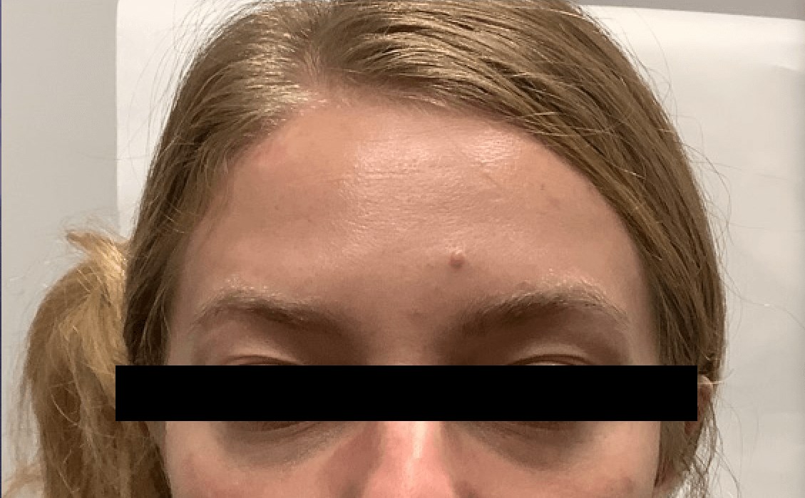 Mole Removal Before