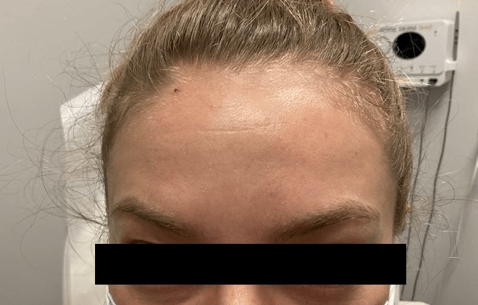 Mole Removal After