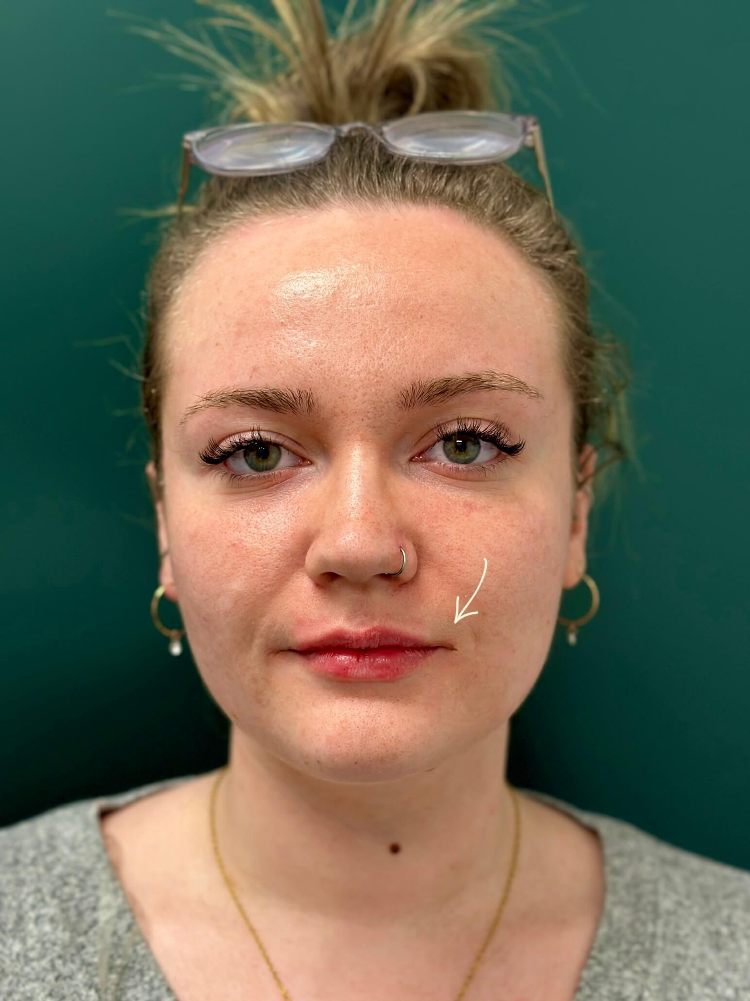 Natural Lip Volume After