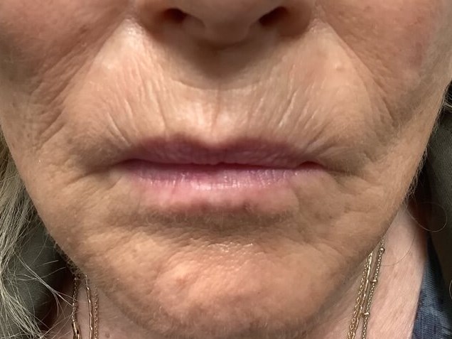 Filler for Fine Lip Lines Before