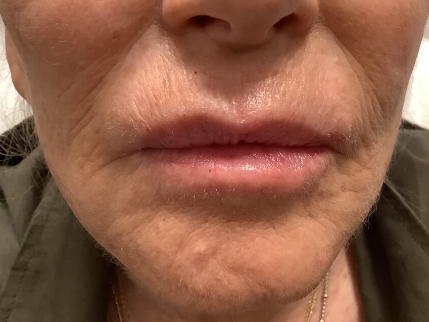 Filler for Fine Lip Lines After