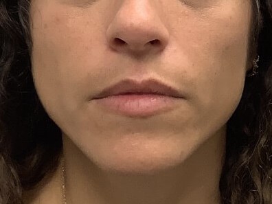 TMJ and Facial Contouring Before