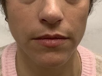 TMJ and Facial Contouring After