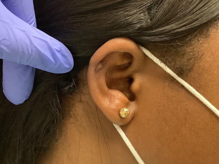 Keloid Removal Surgery After