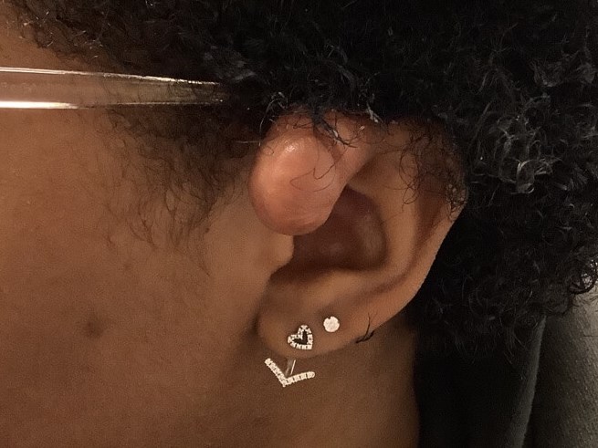 Keloid Removal Treatment Before