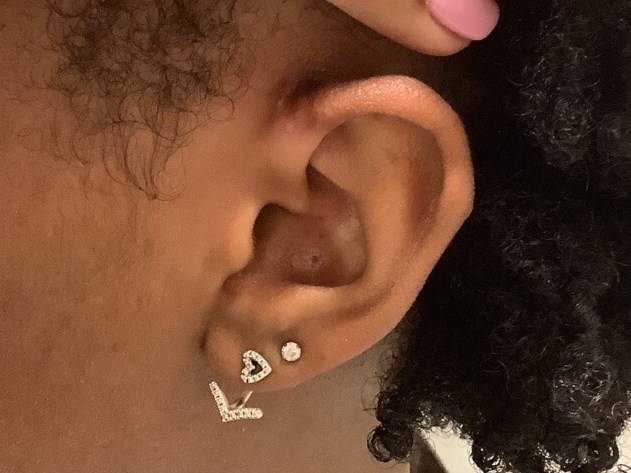 Keloid Removal Treatment After